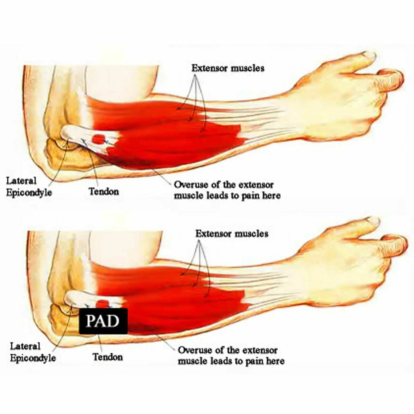 Adjustable Elbow Support Brace Compression Strap Band Protection Tennis Golf - AllTech