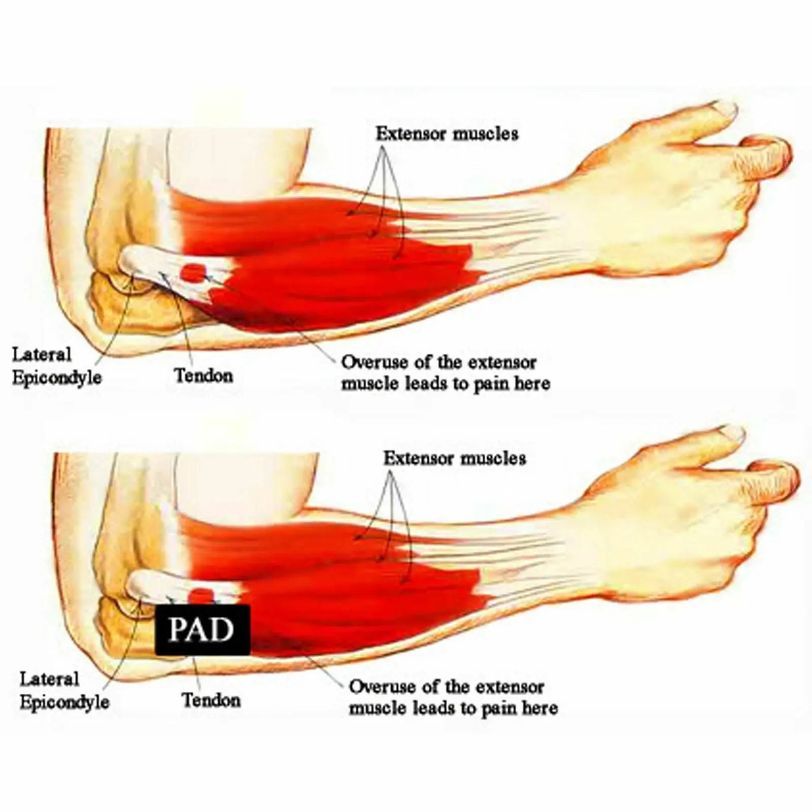 Adjustable Elbow Support Brace Compression Strap Band Protection Tennis Golf - AllTech